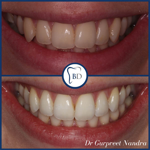 Invisalign & Whitening Before & After 2 Bewdley