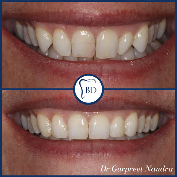 Invisalign & Composite bonding before and after