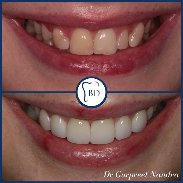Invisalign Whitening & Crowns Before and after 15