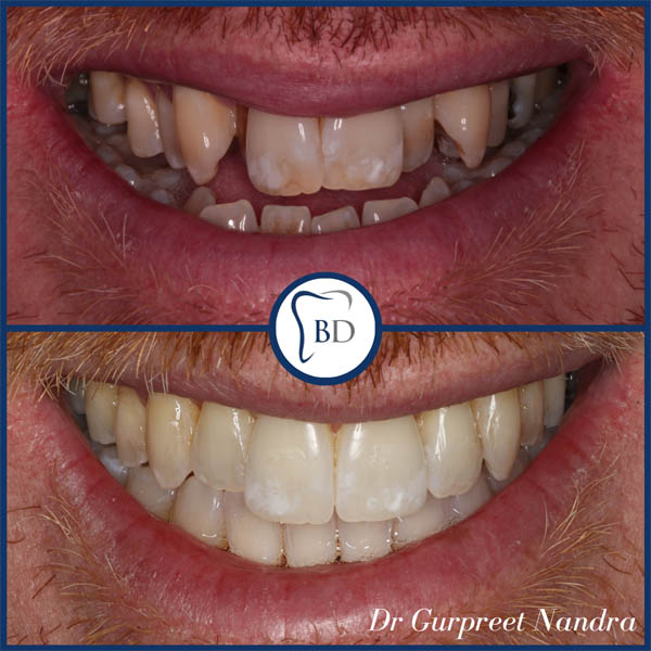 Invisalign before & after bewdley 51