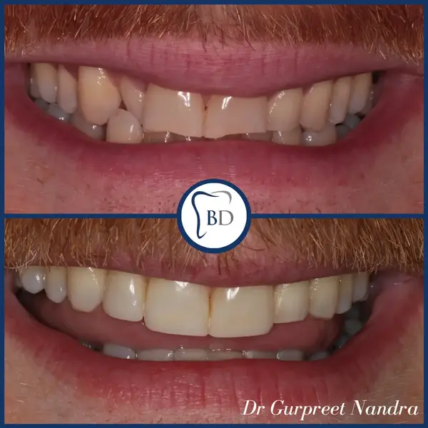Invisalign & Composite bonding before & after 7
