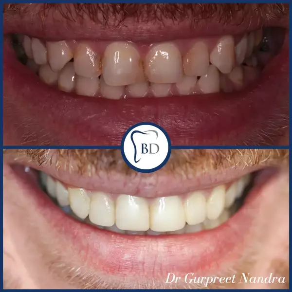 Invisalign & Composite bonding before & after 4