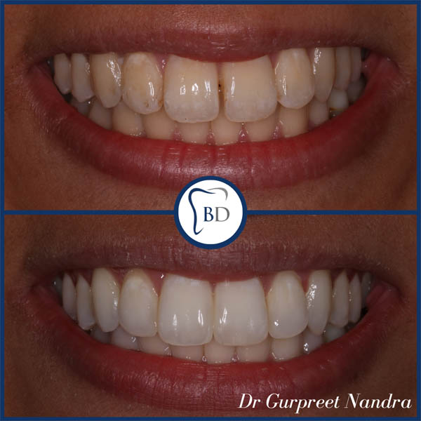 Teeth whitening & composite bonding before and after bewdley 2